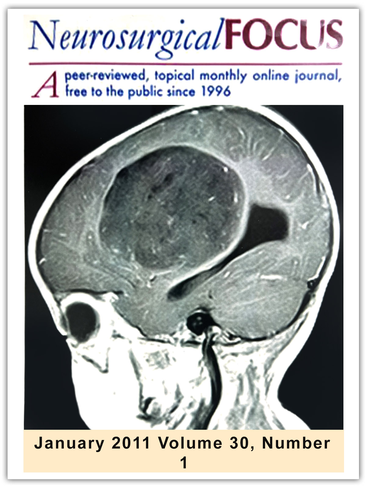 Neurosurgical Focus | volume 30 Issue 1