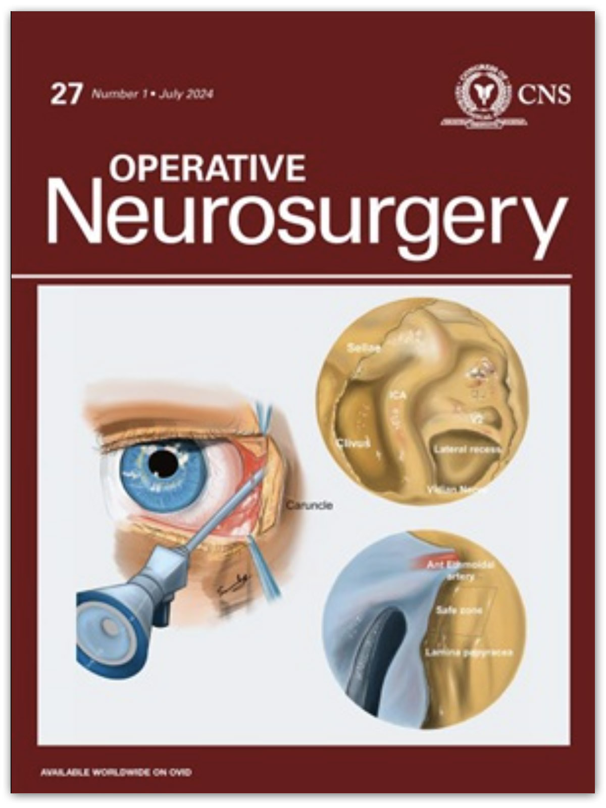 CNS Operative Neurosurgey | July 2024 Volume 27 Issue 1