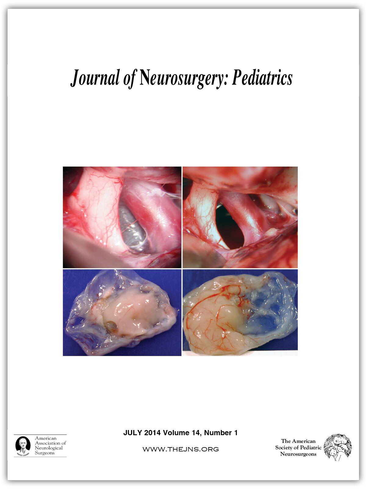 Journal of Neurosurgery: Pediatrics | volume 14 issue 1