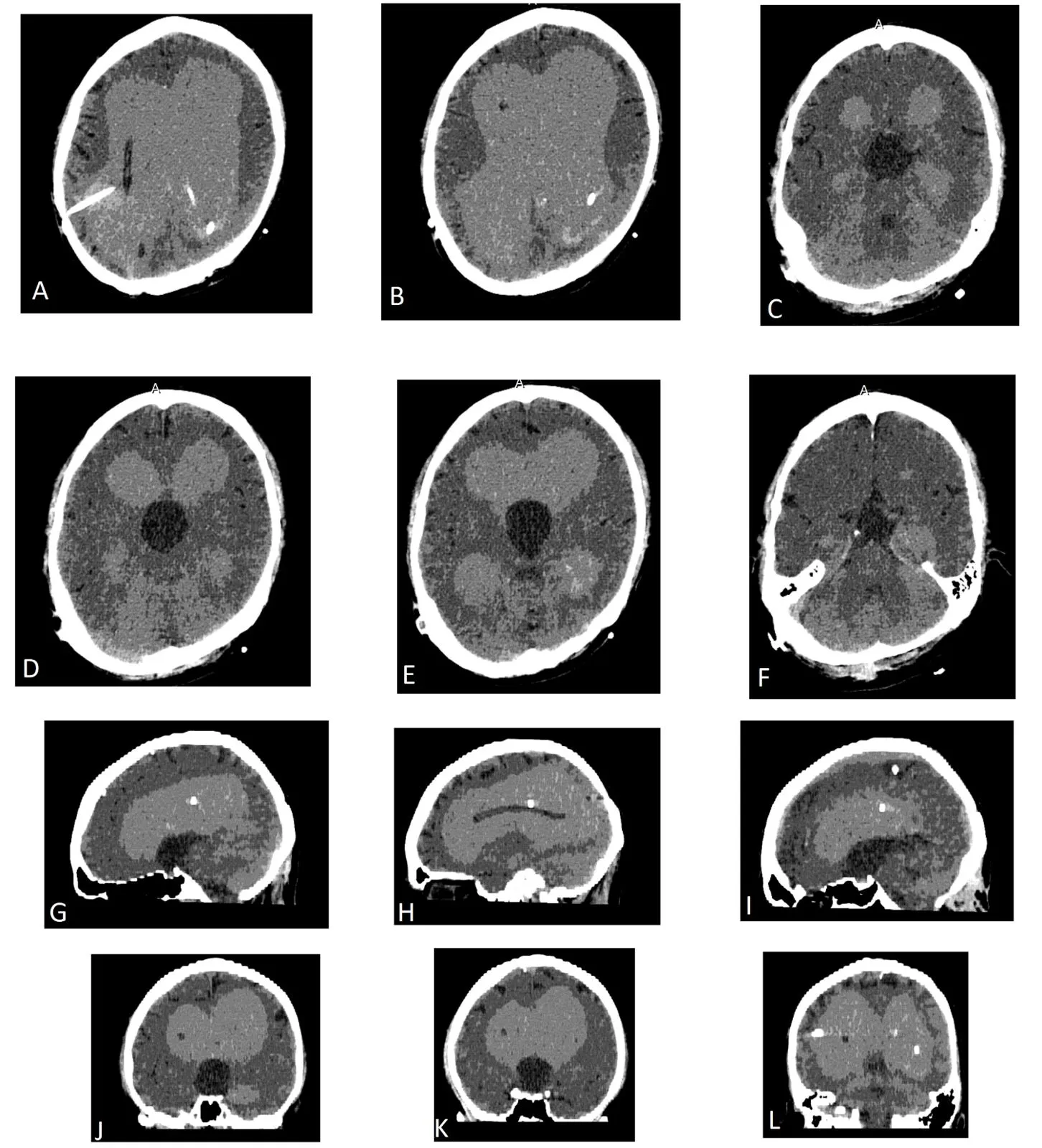 CT ventriculogram in a patient with possible sequestered third ventricle, in the setting of congenital aqueductal stenosis